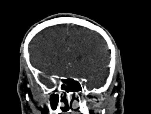 Cerebral arteriovenous malformation (Radiopaedia 78188-90746 Coronal C+ delayed 34).jpg