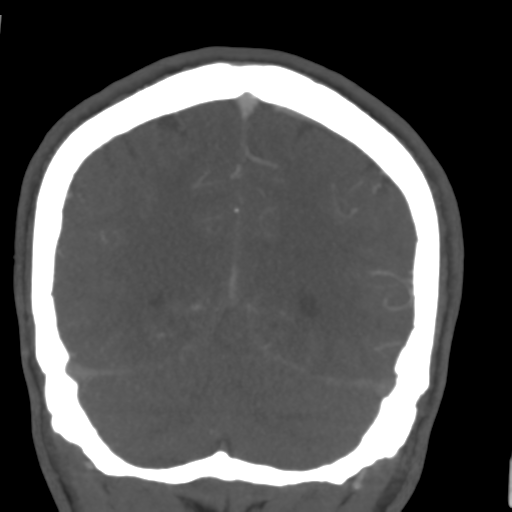 Cerebral arteriovenous malformation (Spetzler-Martin grade 2) (Radiopaedia 41262-44076 F 50).png