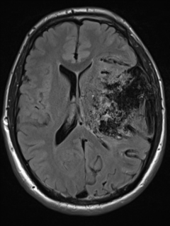 File:Cerebral arteriovenous malformation - huge (Radiopaedia 35734-37272 Axial FLAIR 13).png