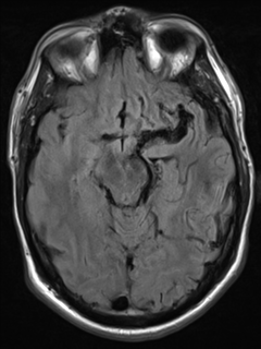 File:Cerebral arteriovenous malformation - huge (Radiopaedia 35734-37272 Axial FLAIR 9).png