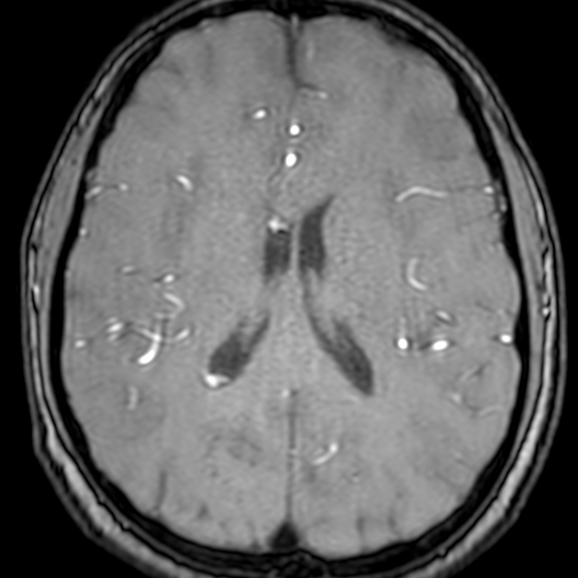 Cerebral arteriovenous malformation at posterior body of corpus callosum (Radiopaedia 74111-84925 Axial MRA 132).jpg