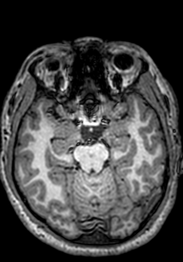 Cerebral arteriovenous malformation at posterior body of corpus callosum (Radiopaedia 74111-84925 Axial T1 197).jpg