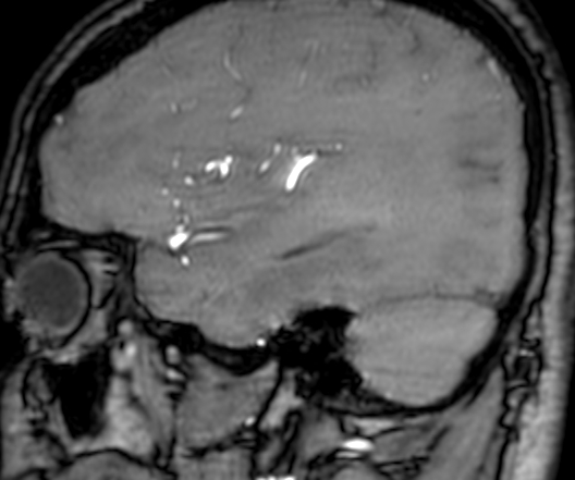 Cerebral arteriovenous malformation at posterior body of corpus callosum (Radiopaedia 74111-84925 J 82).jpg
