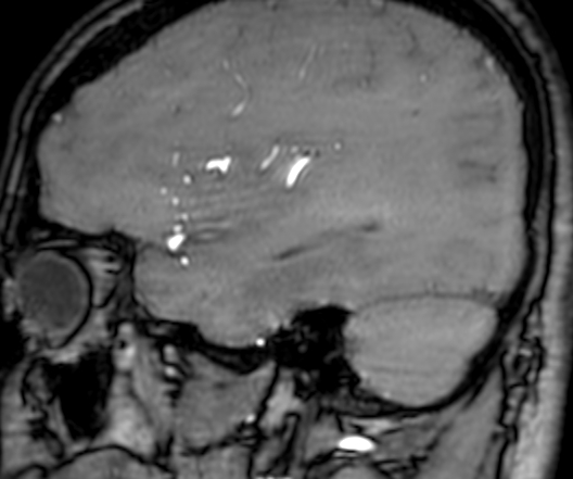Cerebral arteriovenous malformation at posterior body of corpus callosum (Radiopaedia 74111-84925 J 84).jpg