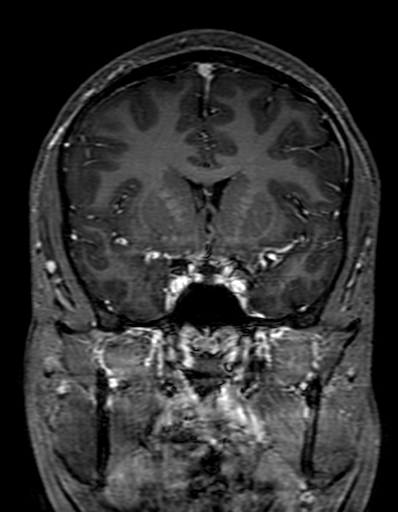Cerebral arteriovenous malformation at posterior body of corpus callosum (Radiopaedia 74111-84925 K 137).jpg