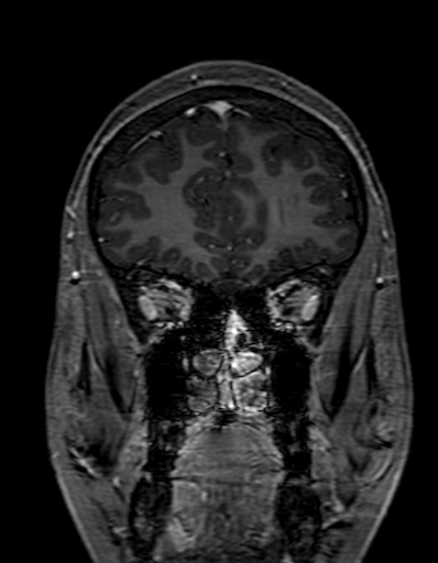 Cerebral arteriovenous malformation at posterior body of corpus callosum (Radiopaedia 74111-84925 K 70).jpg