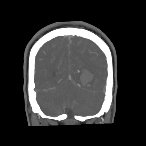 Cerebral arteriovenous malformation with lobar hemorrhage (Radiopaedia 35598-57216 C 74).jpg