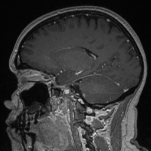 Cerebral cavernoma and development venous anomaly (Radiopaedia 37603-39482 Sagittal T1 C+ 39).png