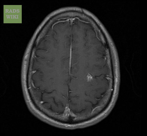 File:Cerebral cavernous malformation (Radiopaedia 11284-11648 Axial 4).jpg