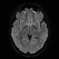 Cerebral cavernous venous malformation (Radiopaedia 70008-80021 Axial DWI 45).jpg