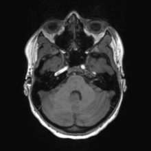 File:Cerebral cavernous venous malformation (Radiopaedia 70008-80021 Axial T1 16).jpg
