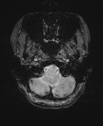 File:Cerebral cavernous venous malformation (Radiopaedia 70008-80021 I 6).jpg