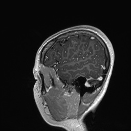 Cerebral cavernous venous malformation (Radiopaedia 70008-80021 Sagittal T1 C+ 11).jpg