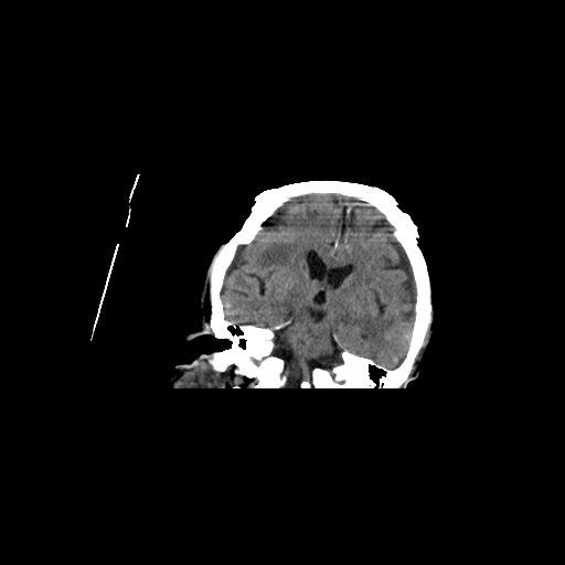 File:Cerebral contusions, subarachnoid hemorrhage and subdural hygromas (Radiopaedia 55399-61830 Axial non-contrast 1).png