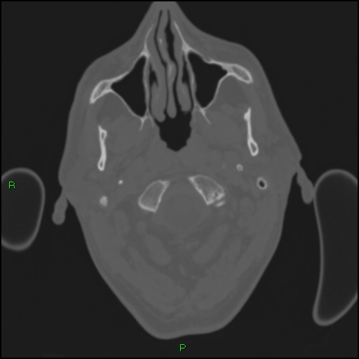 Cerebral contusions (Radiopaedia 33868-35039 Axial bone window 2).jpg