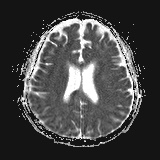 File:Cerebral embolic infarcts (embolic shower) (Radiopaedia 72391-82921 Axial ADC 19).jpg