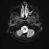 Cerebral embolic infarcts (embolic shower) (Radiopaedia 72391-82921 Axial DWI 2).jpg