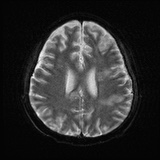 Cerebral embolic infarcts (embolic shower) (Radiopaedia 72391-82921 Axial DWI 20).jpg