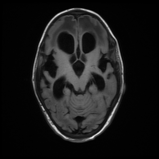 File:Cerebral manifestations of mucopolysaccharidosis type I (Radiopaedia 59171-66487 C 8).jpg