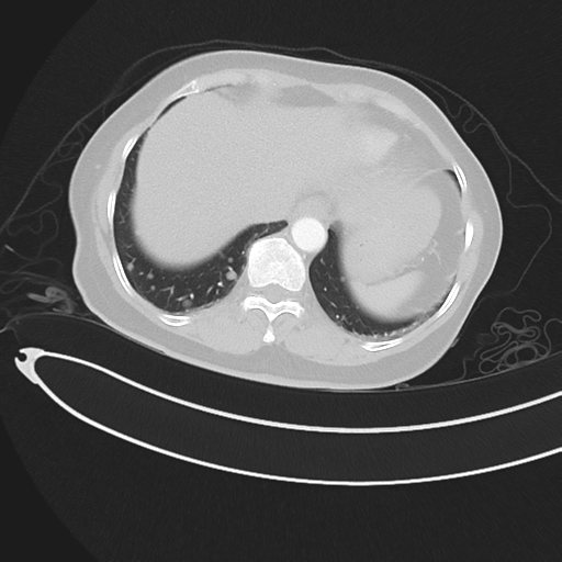 File:Cerebral metastases (Radiopaedia 33041-34055 Axial lung window 45).png