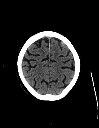Cerebral metastases - ependymal and parenchymal (Radiopaedia 79877-93131 Axial non-contrast 63).jpg