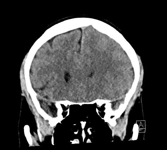 Cerebral metastases - testicular choriocarcinoma (Radiopaedia 84486-99855 Coronal C+ delayed 21).jpg