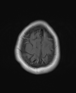 File:Cerebral metastases mimicking abscesses (Radiopaedia 45841-50131 Axial T1 C+ fat sat 26).png
