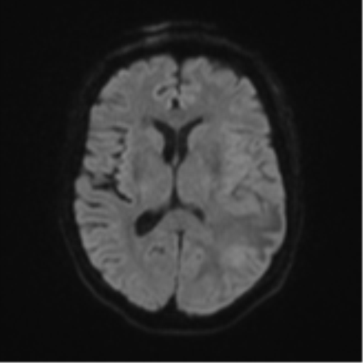 Cerebral metastasis (Radiopaedia 46744-51248 Axial DWI 43).png