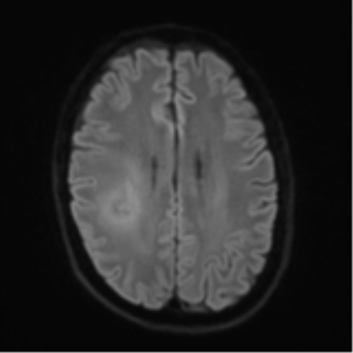Cerebral metastasis - melanoma (Radiopaedia 54718-60954 Axial DWI 50).png
