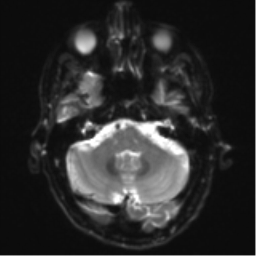 Cerebral metastasis - melanoma (Radiopaedia 54718-60954 Axial DWI 8).png
