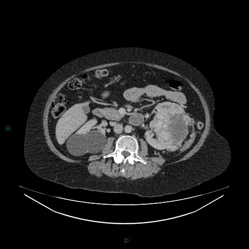 Cerebral metastasis from renal cell carcinoma (Radiopaedia 82306-96378 A 83).jpg