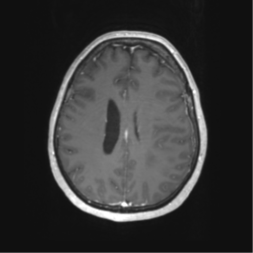 Cerebral metastasis mimicking glioblastoma (Radiopaedia 69155-78937 Axial T1 C+ 45).png