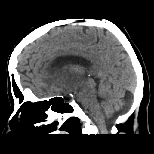 Cerebral metastasis to basal ganglia (Radiopaedia 81568-95412 E 33).png