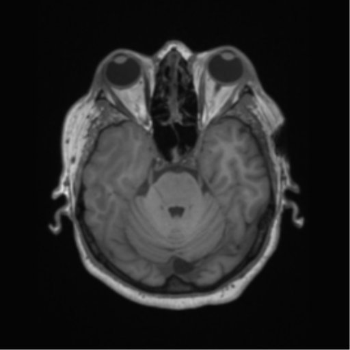 Cerebral metastasis to basal ganglia (Radiopaedia 81568-95413 Axial T1 20).png