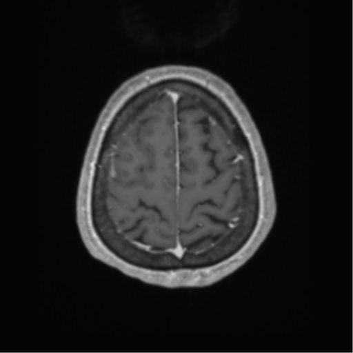 Cerebral metastasis to basal ganglia (Radiopaedia 81568-95413 Axial T1 C+ 64).png