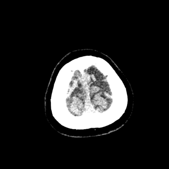 Cerebral ring enhancing lesions - cerebral metastases (Radiopaedia 44922-48818 Axial non-contrast 100).jpg