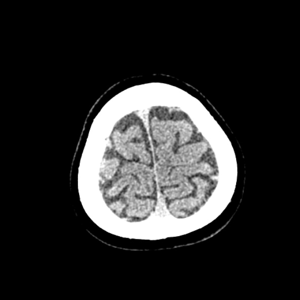 File:Cerebral ring enhancing lesions - cerebral metastases (Radiopaedia 44922-48818 Axial non-contrast 87).jpg