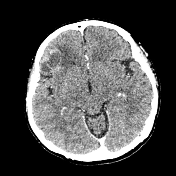 Cerebral ring enhancing lesions - cerebral metastases (Radiopaedia 44922-48818 B 129).jpg
