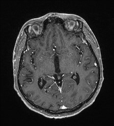 Cerebral toxoplasmosis (Radiopaedia 43956-47461 Axial T1 C+ 33).jpg