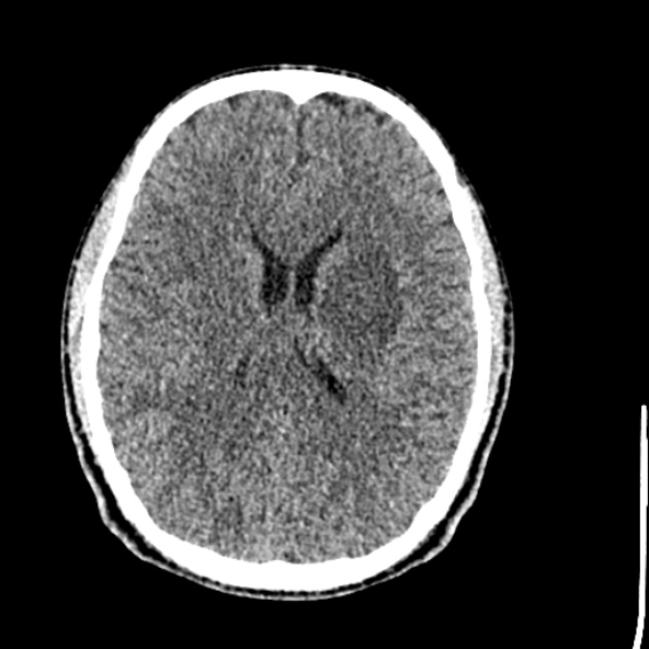 Cerebral toxoplasmosis (Radiopaedia 53993-60131 Axial non-contrast 48).jpg