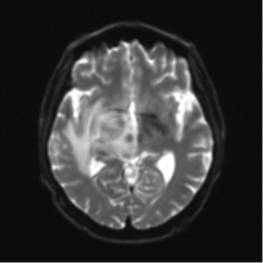 Cerebral toxoplasmosis (Radiopaedia 54575-60804 Axial DWI 16).png