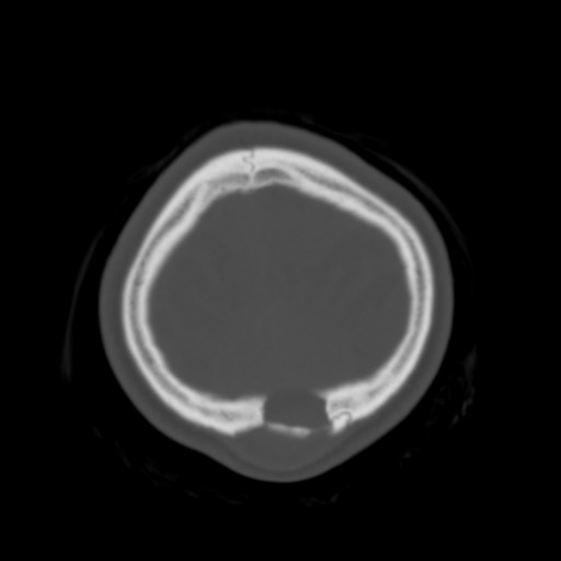 Cerebral tuberculosis with dural sinus invasion (Radiopaedia 60353-68018 Axial bone window 58).jpg
