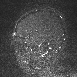 Cerebral tuberculosis with dural sinus invasion (Radiopaedia 60353-68090 Sagittal MRV 31).jpg