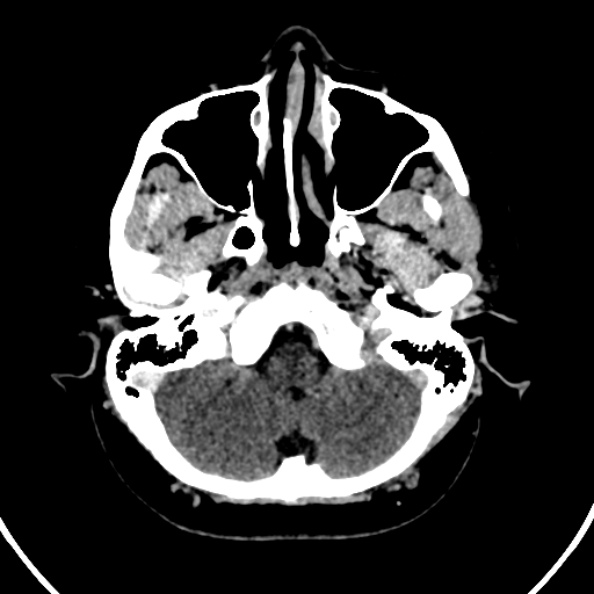 Cerebral venous hemorrhagic infarct from venous sinus thrombosis (Radiopaedia 55433-61883 Axial C+ delayed 126).jpg