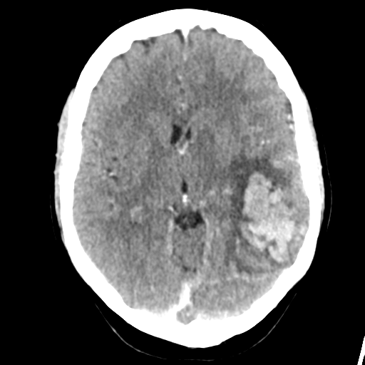Cerebral venous hemorrhagic infarction (Radiopaedia 57576-64538 Axial C+ 22).png