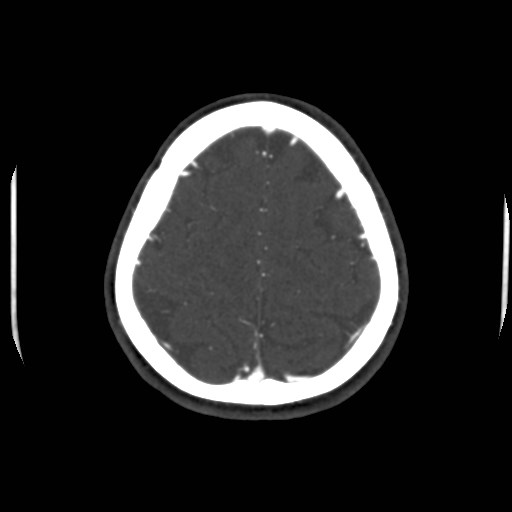 Cerebral venous sinus thrombosis (Radiopaedia 40619-43227 A 193).jpg