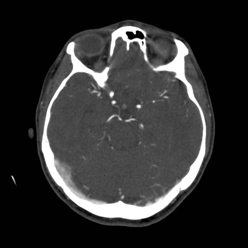 Cerebral venous sinus thrombosis (Radiopaedia 40619-43227 A 84).jpg