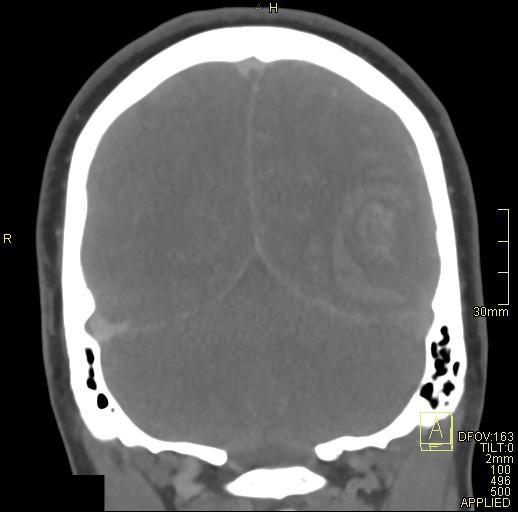 File:Cerebral venous sinus thrombosis (Radiopaedia 91329-108965 Coronal venogram 68).jpg