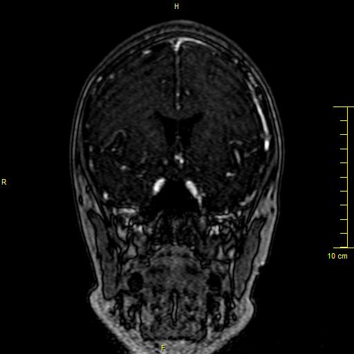 Cerebral venous thrombosis (Radiopaedia 23288-23351 MRV 44).JPG