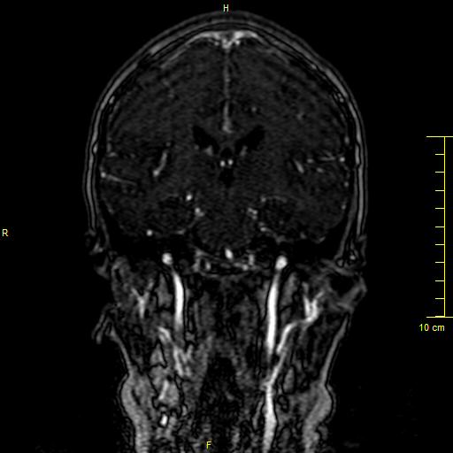 Cerebral venous thrombosis (Radiopaedia 23288-23351 MRV 83).JPG